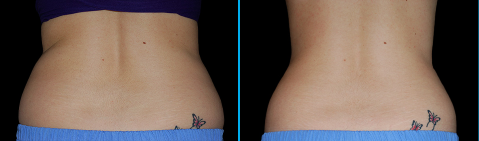How Long Does CoolSculpting Last?